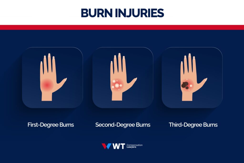 burn injuries