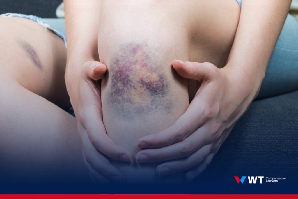 knee injury settlement calculator